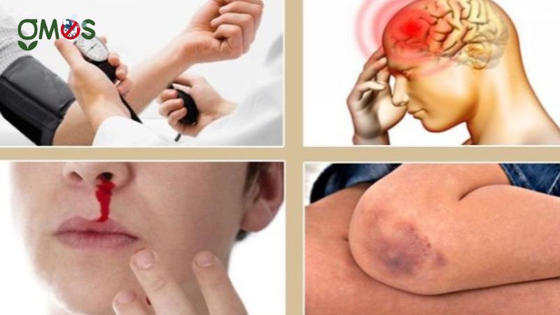 Biến chứng nguy hiểm của bệnh sốt xuất huyết