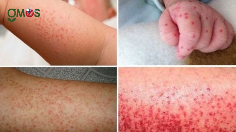 Giấu hiệu nguy hiểm của bệnh sốt xuất huyết của trẻ em