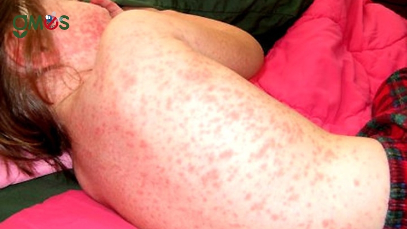 Tại sao sốt xuất huyết ở trẻ em lại nguy hiểm